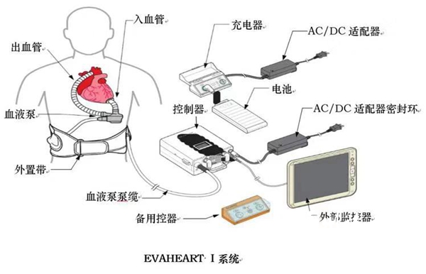 福建省心衰病人可植入免費(fèi)人工心臟